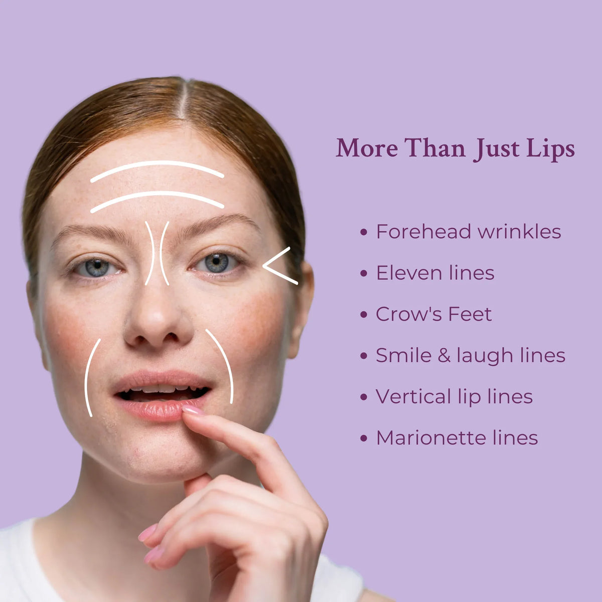 Close-up photo of smooth lips and areas around mouth demonstrating lip and line filler use.